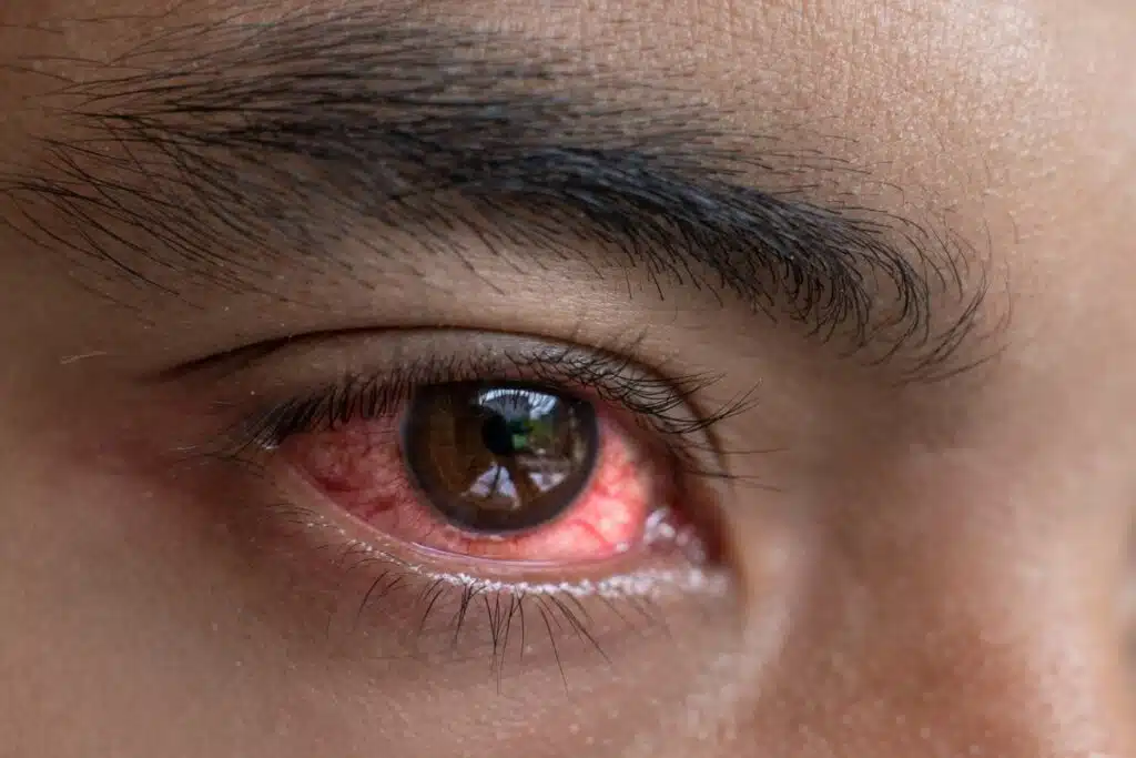 Why Does Marijuana Make Your Eyes Red