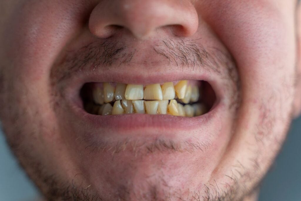 A person with nicotine-stained teeth due to excessive use